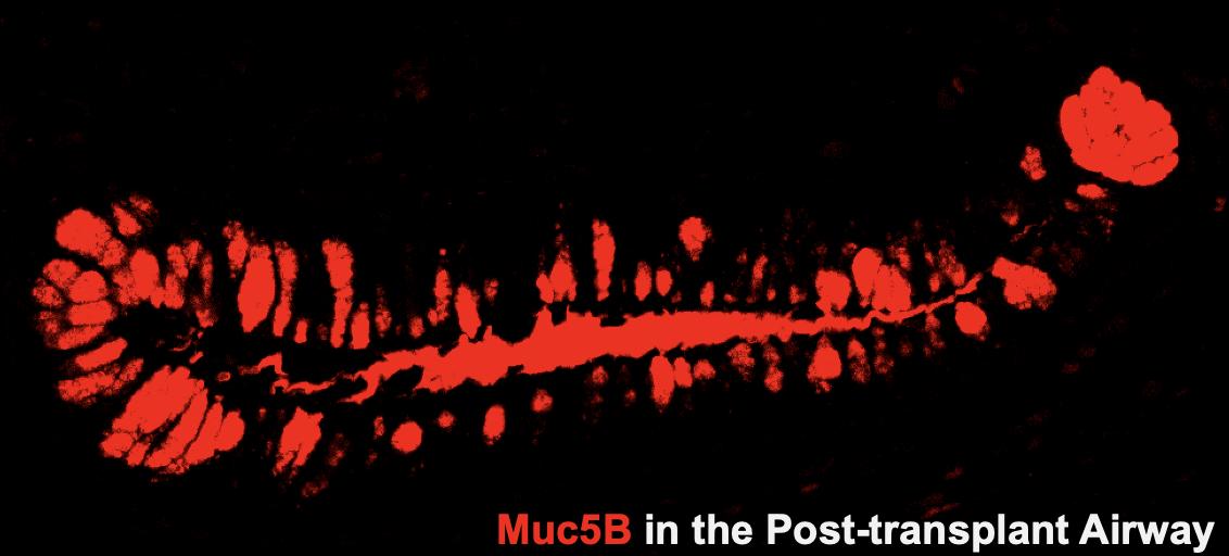 Post-transplant airways exhibit marked MUC5B upregulation